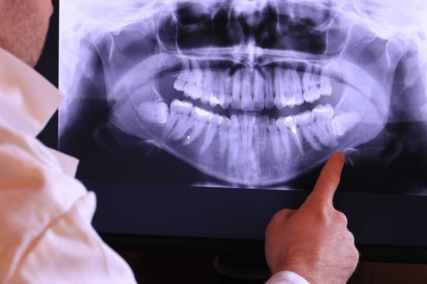 Best Emergency Root Canal Therapy in Warren, IN