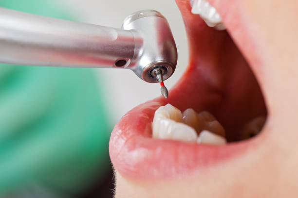 Best Broken or Chipped Tooth Repair in Warren, IN